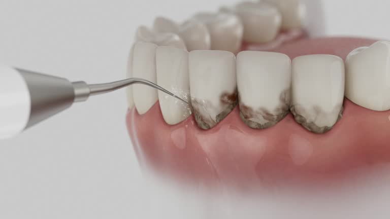 Reliable Dental Implants contractor in Keasbey, NJ by Smile Center Dentistry